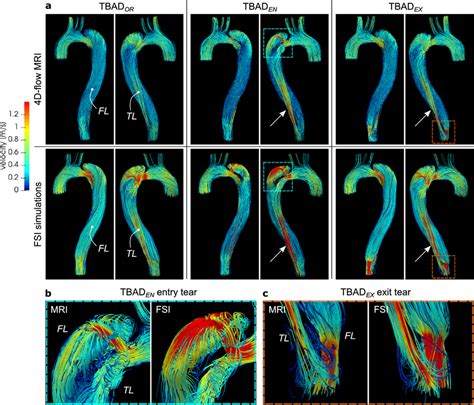 A Streamlines At Peak Systole T 200 Ms Rendered From 4D Flow MRI