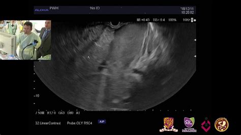 Case 4 Contrast Enhancement Eus And Eus Guided Fine Needle Aspiration