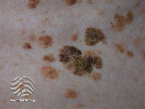 Skin Coloured Seborrheic Keratosis Infoupdate Org