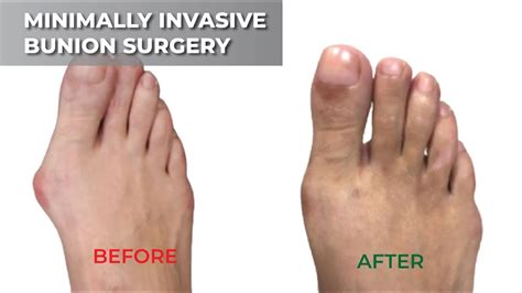 Minimally Invasive Bunion Surgery Youtube