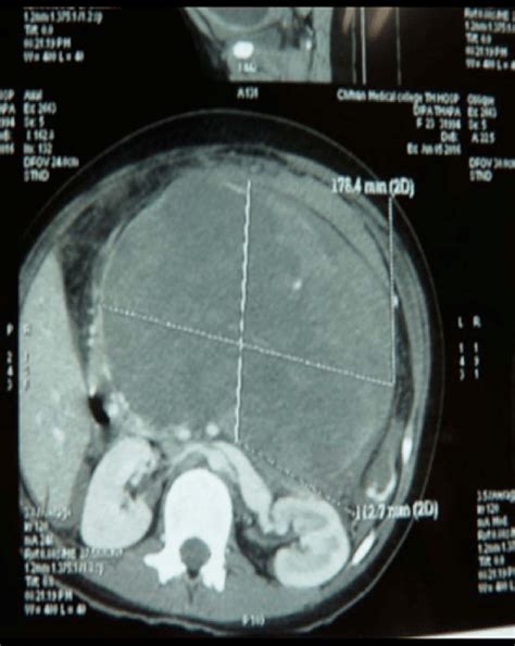 CT axial image shows well-defined heterogeneously enhancing mass ...