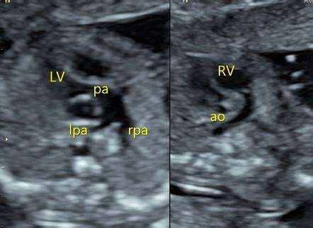 Transposition Of The Great Arteries TGA Fetal Echocardiogram