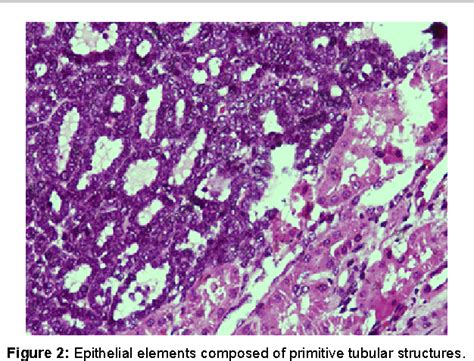 Figure 2 From Adult Nephroblastoma Wilms Tumor A Case Report