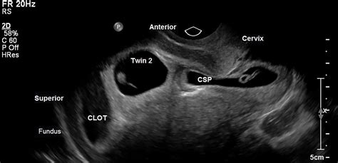 Heterotopic Caesarean Section Scar Ectopic Oandg Magazine