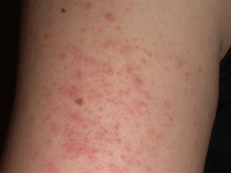 What Does Keratosis Pilaris Look Like Balmonds
