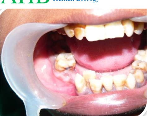 Figure 1 From Multinucleated Giant Cells In Unicystic Ameloblastoma A