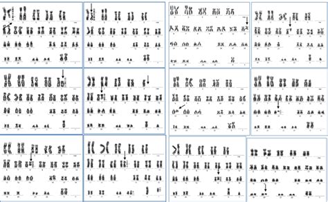 Terminal And Interstitial Deletions Arrowed In Autosomes And Sex Download Scientific Diagram
