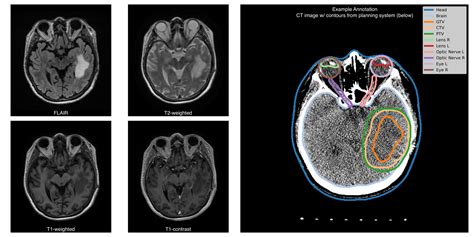 BURDENKO GBM PROGRESSION The Cancer Imaging Archive TCIA