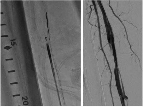 Single Center Outcomes Of Percutaneous Deep Vein Arterialization In