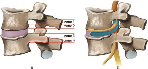 A Four Anatomic Zones And Levels Of Disc Herniation As Divided By