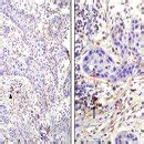 Mmunohistochemical Staining For HMGB 1 In Oral Cavity SCC A X200 B