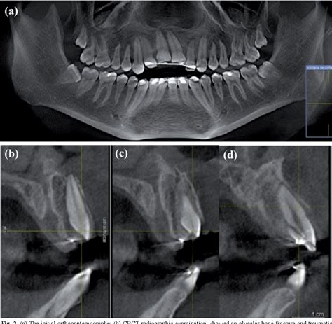 Alveolar Bone Fracture