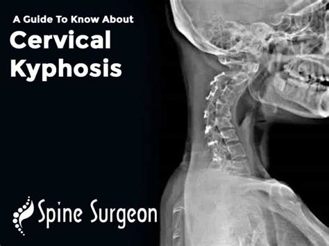 A Guide To Know About Cervical Kyphosis Spine Surgeon