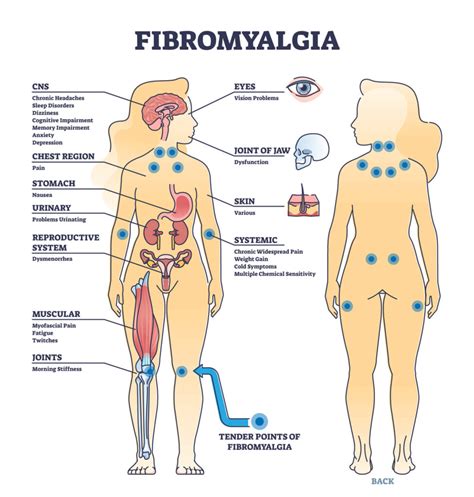 Fibromyalgia - Symptoms, Causes, and Natural Treatment!