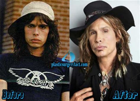 Steven Tyler Plastic Surgery Before and After Pictures