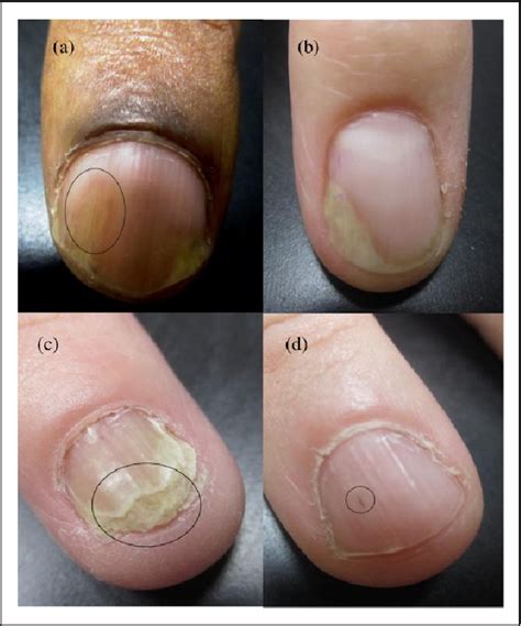 Psoriasis Nails Subungual Hyperkeratosis