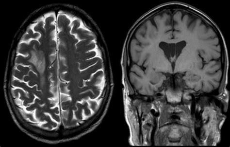 Leucoencefalopatia Sintomas Causas E Tratamento Maestrovirtuale