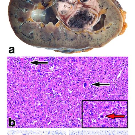 Epithelioid Angiomyolipoma A The Gross Picture Shows A Necrotic