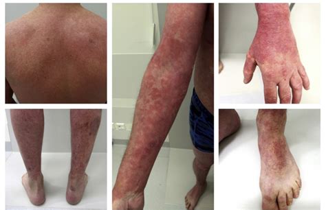 Eczematous Eruption After Guselkumab Treatment For Psoriasis