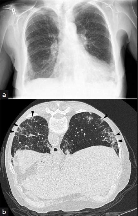 Rheumatoid Lung Disease