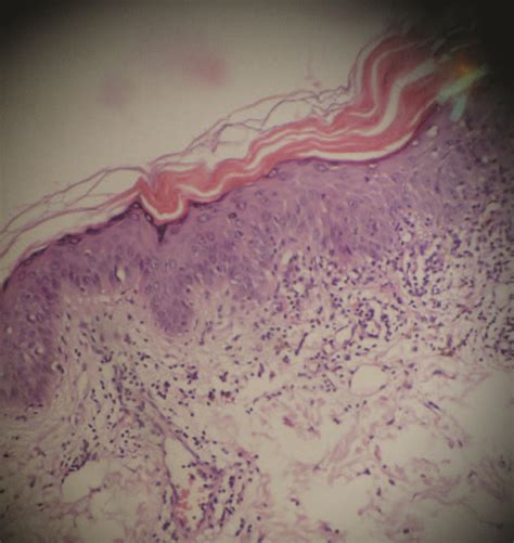 Hyperkeratosis Lenticularis Perstans Case Report Of A Rare Entity