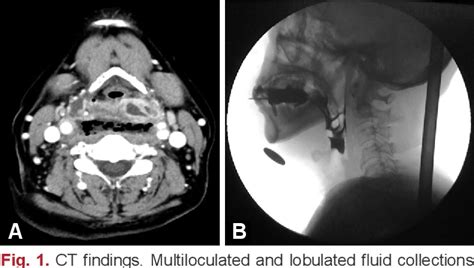 Figure 1 From Dysphagia After Retropharyngeal Abscess Treated With