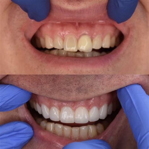 Before And After Veneers Procedure Dr Christian Chung D D S