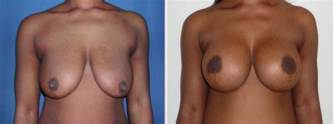 Plastie Mammaire Lifting Implants Sur Peau Noire Dr Ouakil