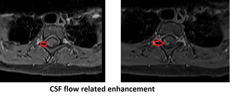 Flow Artifact Mri Csf Flow Artifact