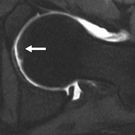 Ligamentum Teres