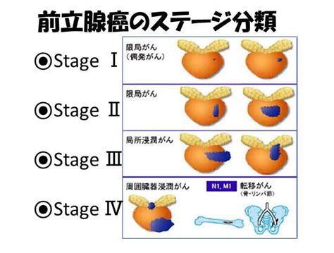 ステージⅣの前立腺癌患者さん 開業医こぼれ話