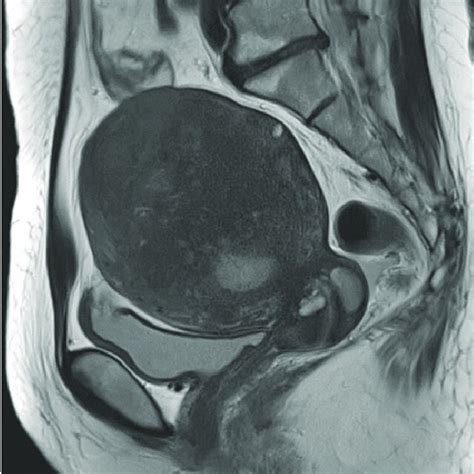 Magnetic Resonance Imaging Shows Diffuse Enlargement Of The Uterus With