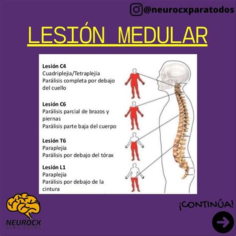 LESIÓN MEDULAR Y SU CLASIFICACIÓN Neurocirugía Para Todos uDocz