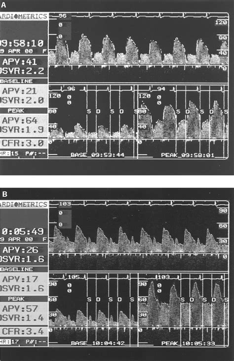 Normal Coronary Flow Reserve After Arterial Switch Operation For