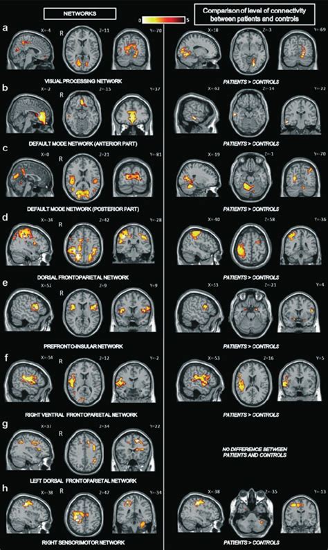 Differences In Resting State Networks Synchronization Between Patients