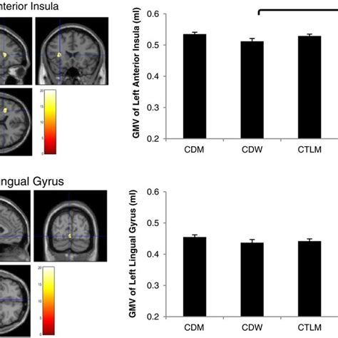 Diagnosis × Gender Interactions In Gray Matter Volume Structural Download Scientific Diagram