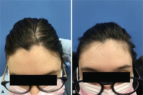 Case 2 Frontal Scalp Response To Platelet Rich Plasma Injections At