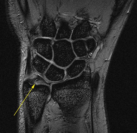 Wrist Ligaments Mri