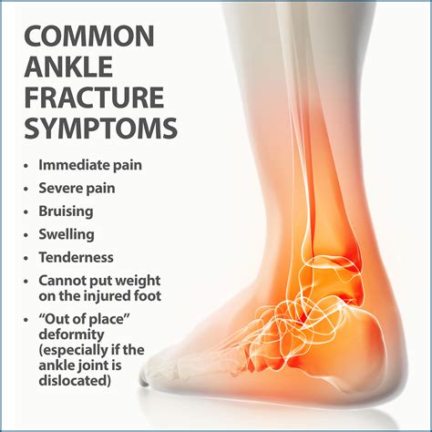 Ankle Fractures Broken Ankle Florida Orthopaedic Institute