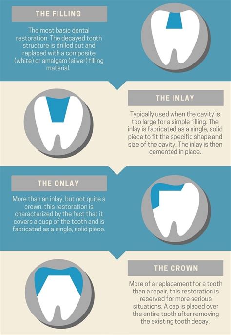 Dental Inlays And Onlays Differences Pros And Cons And More