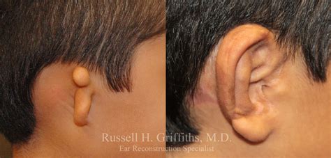 Case One Stage Microtia Reconstruction Rib Graft Before And