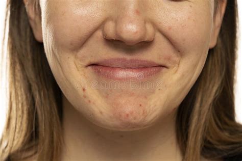 Young Smiling Woman With The Pimples On Her Face Stock Photo Image Of