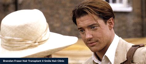 Brendan Fraser Hair Transplant - Smile Hair Clinic