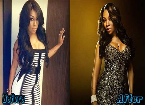 K. Michelle Plastic Surgery Before and After