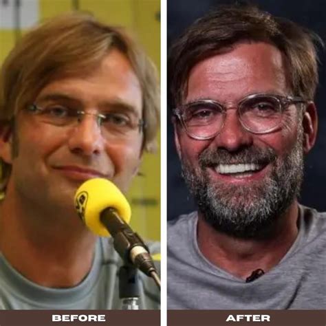 10 Incredibly Pictures Of Jurgen Klopp’s New Hair Transplant