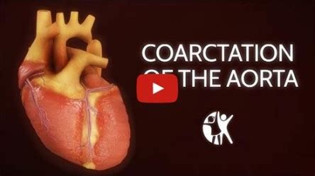 Coarctation-of-the-Aorta-Animation-Signs-and-Symptoms-Diagnosis ...