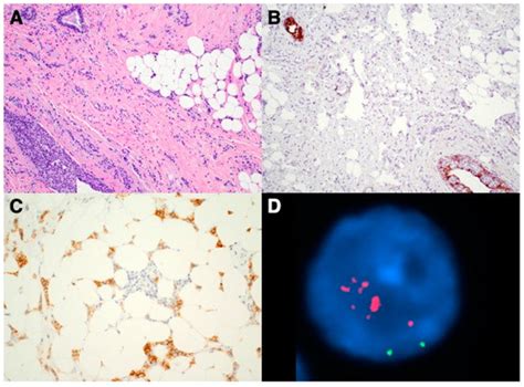 Her2 Positive And Her2 Negative Classical Type Invasive Lobular