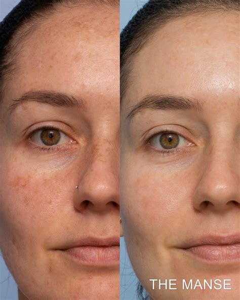 Pigmentation Treatment Best Cosmetic Clinic Sydney Advanced