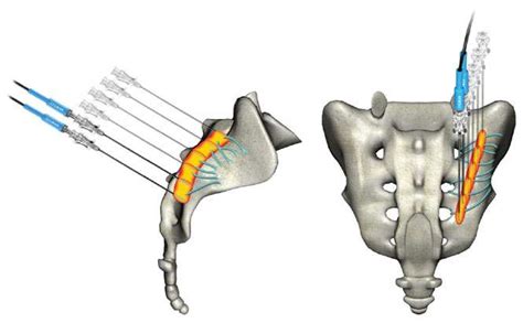 Ablation With RFA Procedure And Recovery PainMed Clinic