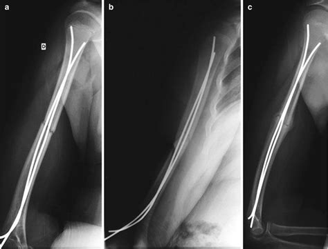 Enders Nail Femur Fracture Nail Ftempo